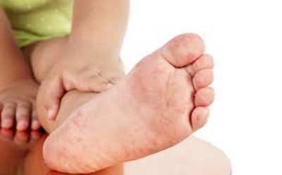 Dấu hiệu bệnh tay chân miệng và cách điều trị – Đừng để dịch tay chân miệng tăng đột biến “căng tin biến thành phòng bệnh”
